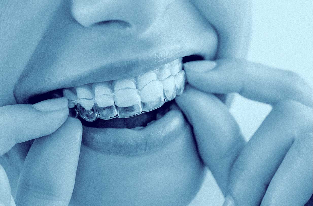 particolare di donna sorridente che applica un apparecchio invisibile ai denti