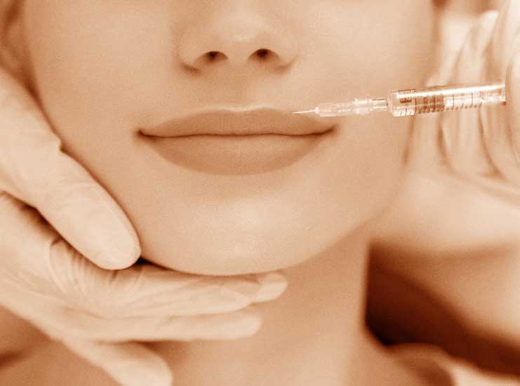 Primo piano di un trattamento filler labbra di acido ialuronico