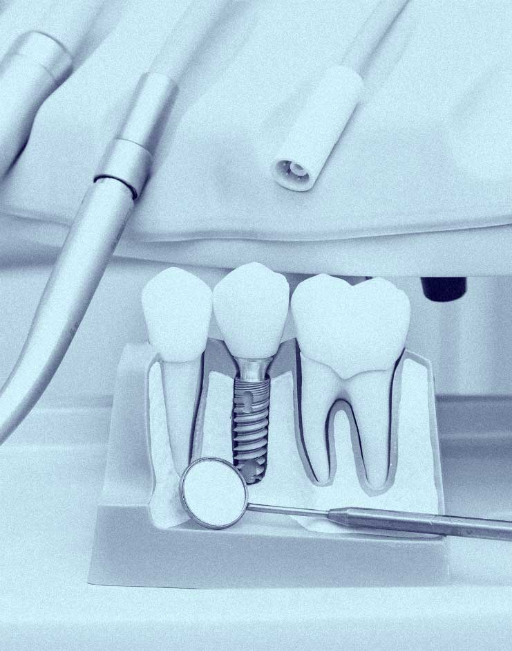 Implantologia, primo piano di un modello di impianti dentali
